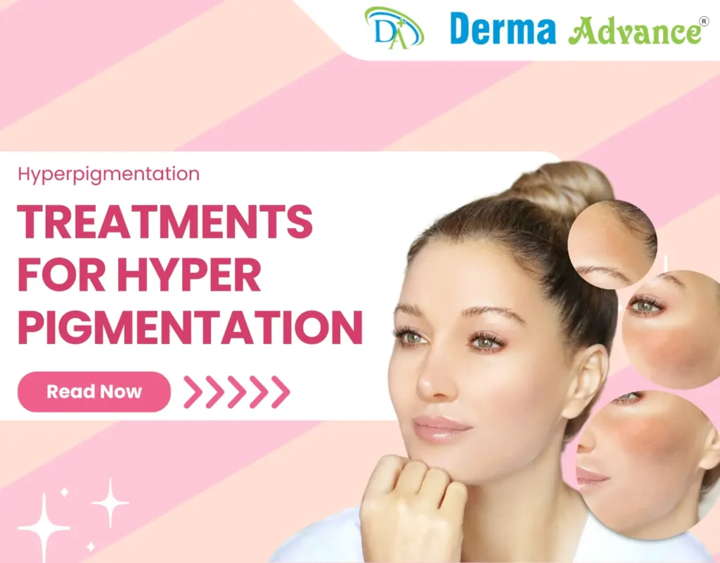 Featured Image of Treatments for Hyperpigmentation