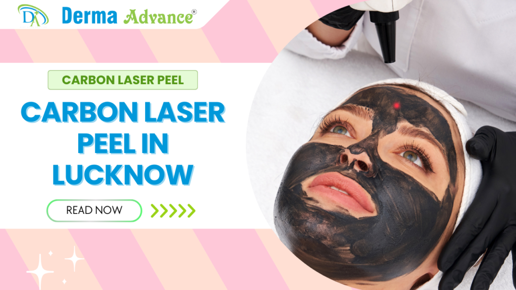 Carbon Laser Peel treatment in progress at a dermatology clinic in Lucknow, with the laser targeting skin imperfections