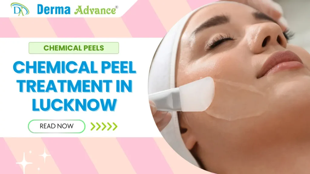 Featured image of chemical peel treatment at Derma Advance in Lucknow