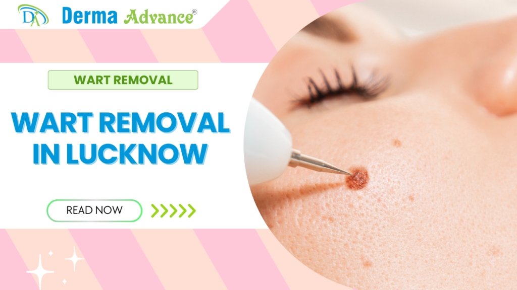 Wart Removal in Lucknow