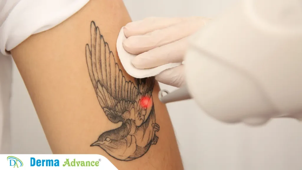 Laser Tattoo Removal Explained – Non-invasive process to remove unwanted tattoos effectively.