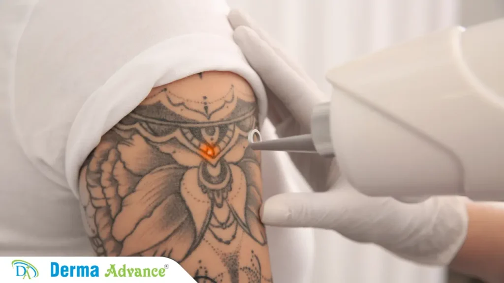 Top Benefits of Laser Tattoo Removal – Safe, effective, and permanent results.