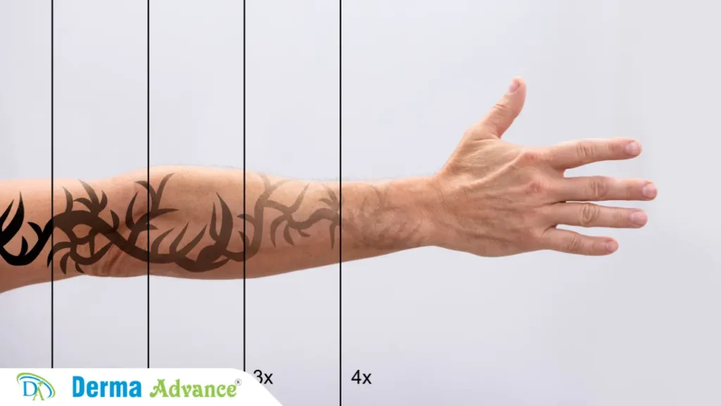 Tattoo Removal Process – Demonstrating how a tattoo fades with each laser treatment session.