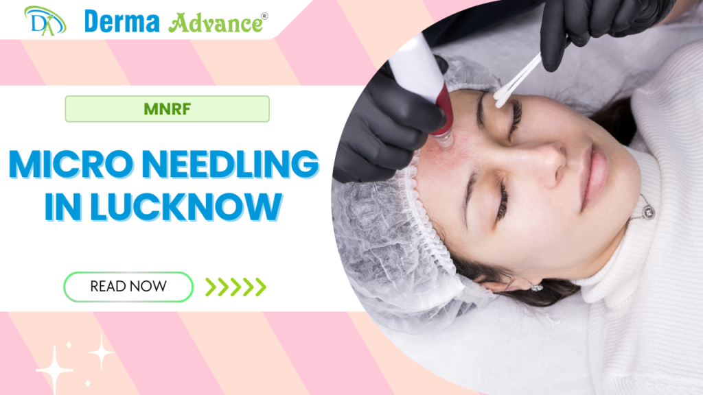 MNRF treatment in Lucknow for skin rejuvenation at Derma Advance