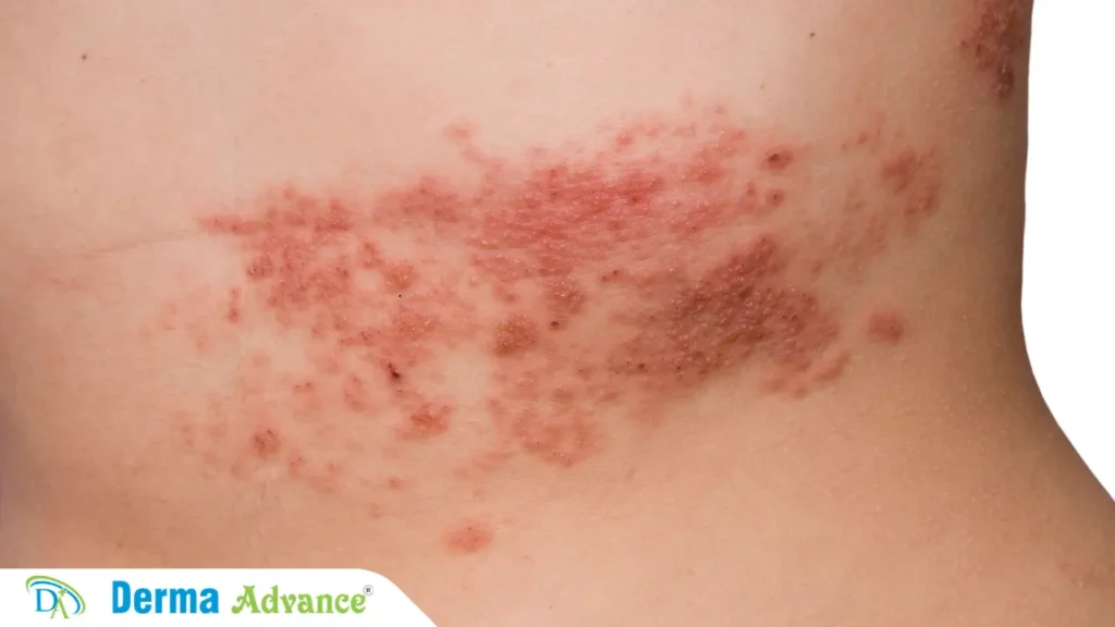 Excimer Laser treating psoriasis patches at Derma Advance in Lucknow.