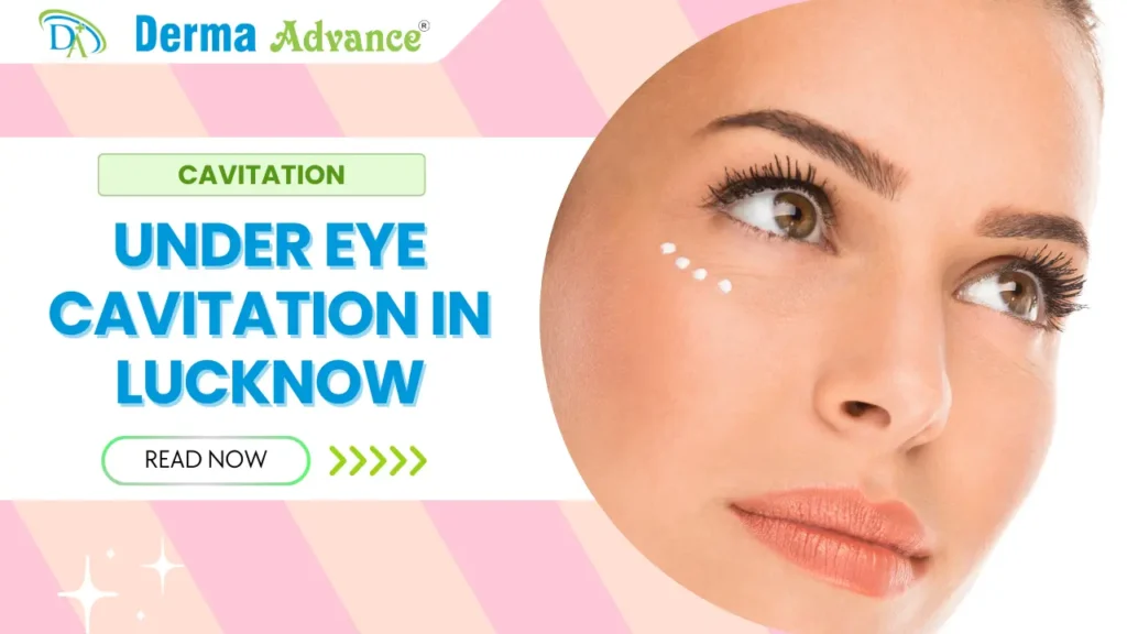 Under Eye Cavitation treatment at Derma Advance in Lucknow