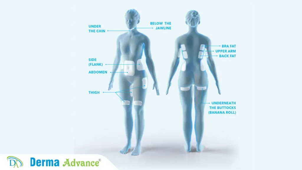 Targeted areas for cryolipolysis treatment in Lucknow, including abdomen, thighs, arms, and flanks.