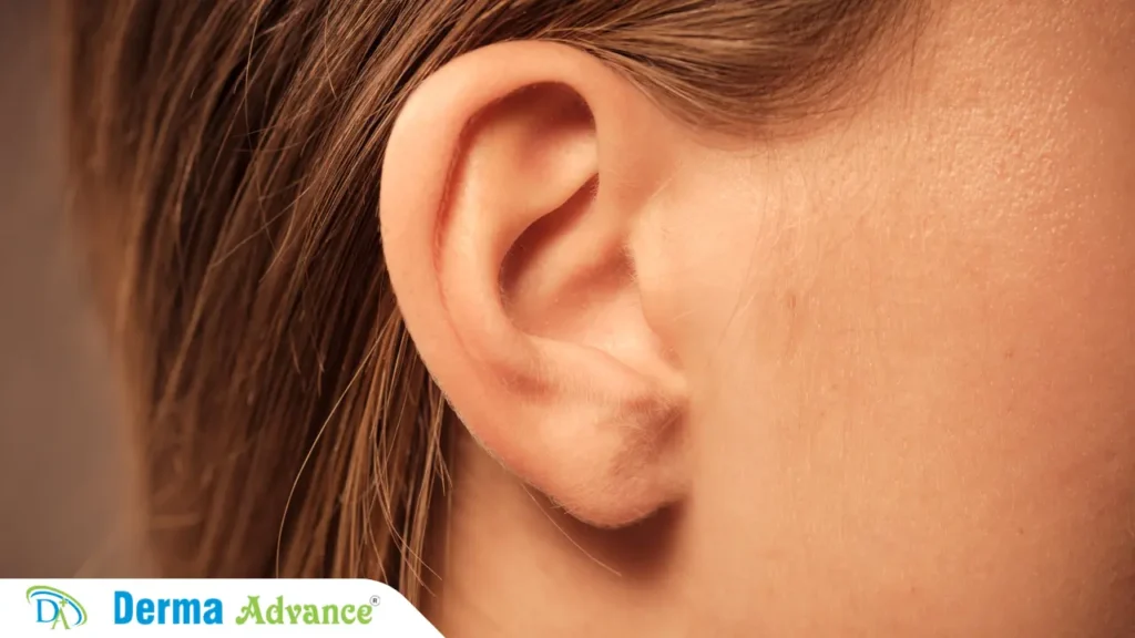 Explanation of Ear Loops Surgery at Derma Advance in Lucknow