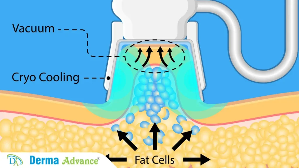 Understanding cryolipolysis treatment in Lucknow: a non-surgical method for reducing fat and contouring the body.