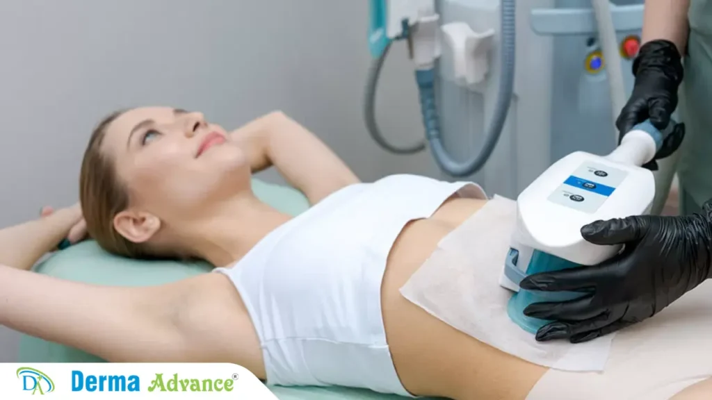 Benefits of choosing cryolipolysis in Lucknow, including advanced technology and experienced specialists at Derma Advance.