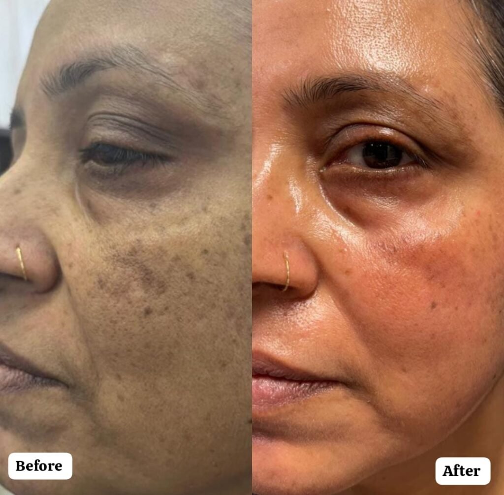 Are you tired of dealing with stubborn pigmentation, uneven skin tone, or dark spots that just won’t go away? Cosmelan Treatment in Lucknow – Your Solution for Stubborn Pigmentation